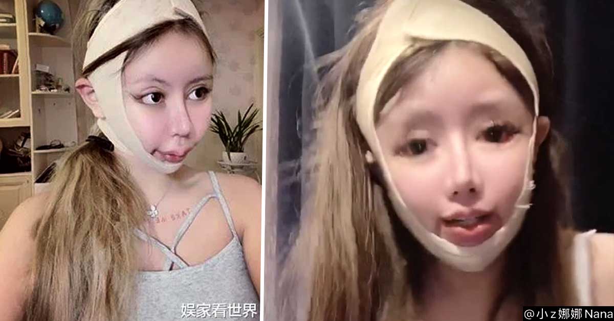 girl 16 allegedly undergoes 100 plastic surgeries in only 3 years - Jovem de 16 de anos faz mais de 100 cirurgias plásticas em apenas 3 anos