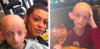 Adolescente com doença que envelheceu seu corpo 144 anos viveu até completar 18 anos Adolescente com doença que envelheceu seu corpo 144 anos viveu até completar 18 anos