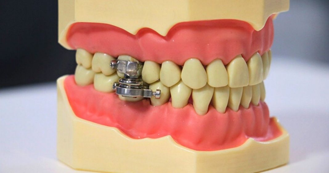 Aparelho para emagrecer que trava os dentes gera polêmica – É só “fechar a boca”?