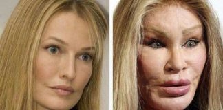 Casos chocantes de famosas que aderiram a procedimentos estéticos extremos Casos chocantes de famosas que aderiram a procedimentos estéticos extremos