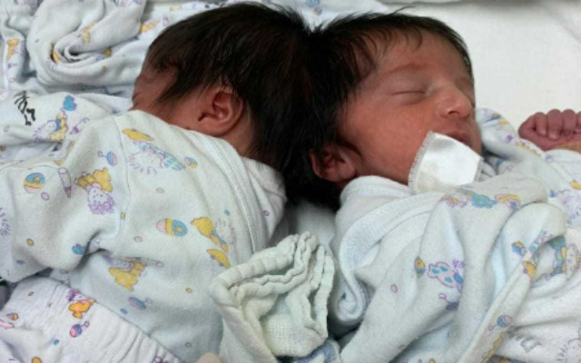 ideiasnutritivas.com - Irmãs gêmeas unidas se veem pela primeira vez depois de cirurgia que separou suas cabeças