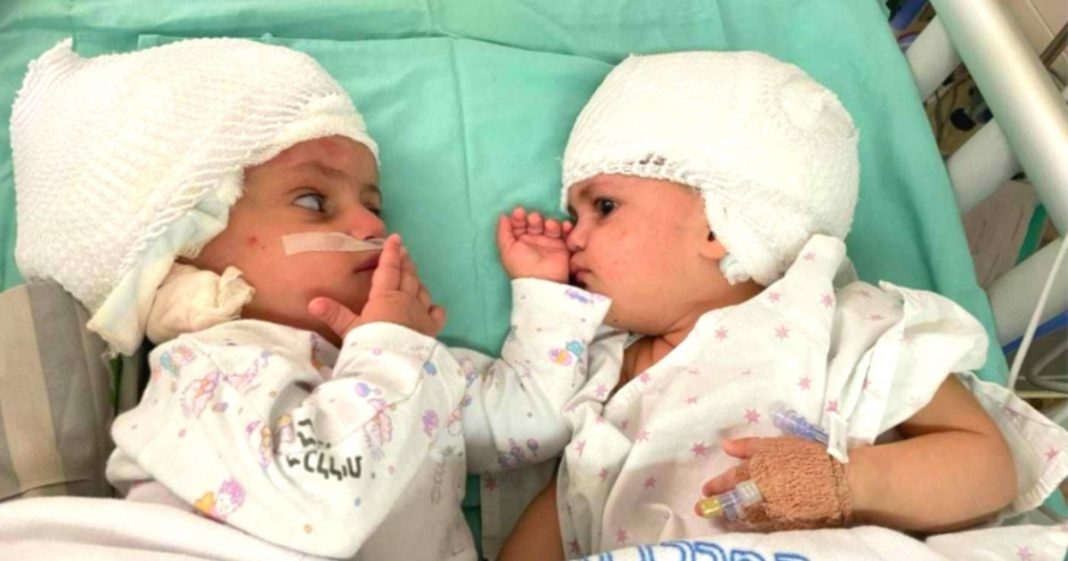 Irmãs gêmeas unidas se veem pela primeira vez depois de cirurgia que separou suas cabeças