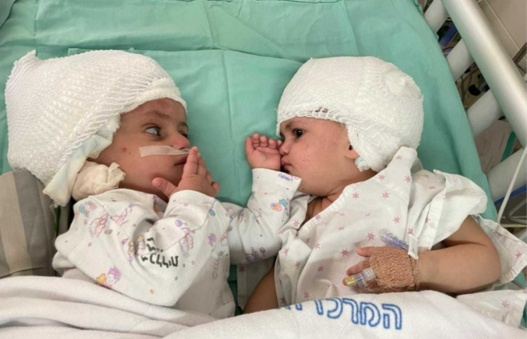 irmas gemeas unidas se veem pela primeira vez depois de cirurgia que separou suas cabecas 3 - Irmãs gêmeas unidas se veem pela primeira vez depois de cirurgia que separou suas cabeças