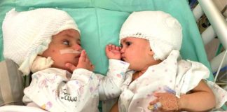 Irmãs gêmeas unidas se veem pela primeira vez depois de cirurgia que separou suas cabeças Irmãs gêmeas unidas se veem pela primeira vez depois de cirurgia que separou suas cabeças