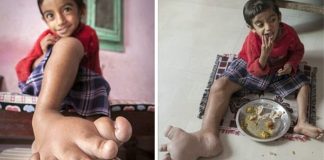 Por que na Índia existem tantas pessoas com anomalias congênitas? Por que na Índia existem tantas pessoas com anomalias congênitas?