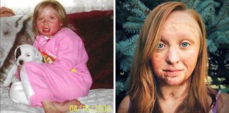 “Fiquei em chamas quando minha mãe usou GASOLINA para tratar meus piolhos e depois acendeu um cigarro” “Fiquei em chamas quando minha mãe usou GASOLINA para tratar meus piolhos e depois acendeu um cigarro”