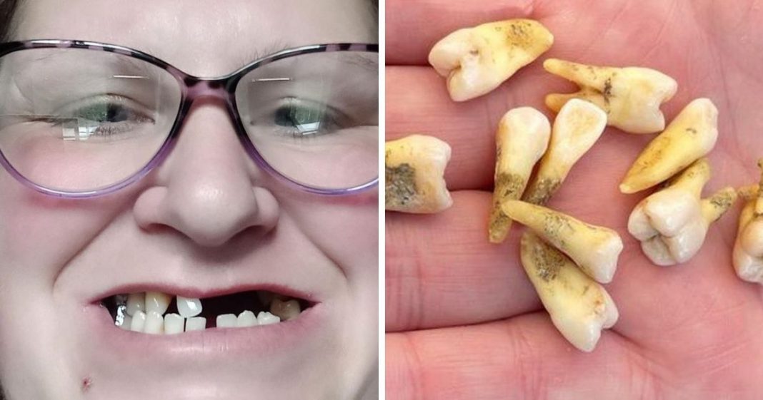 Mãe remove 11 dos próprios dentes porque não tinha dinheiro para ir a um dentista particular