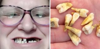 Mãe remove 11 dos próprios dentes porque não tinha dinheiro para ir a um dentista particular Mãe remove 11 dos próprios dentes porque não tinha dinheiro para ir a um dentista particular