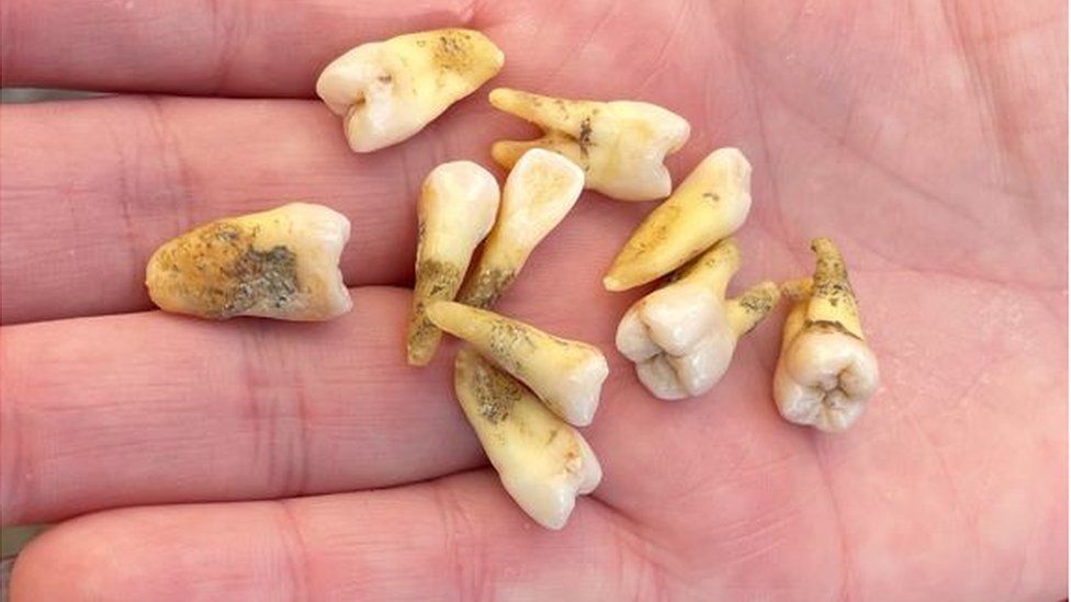 Mãe remove 11 dos próprios dentes porque não tinha dinheiro para ir a um dentista particular ideiasnutritivas.com - Mãe remove 11 dos próprios dentes porque não tinha dinheiro para ir a um dentista particular