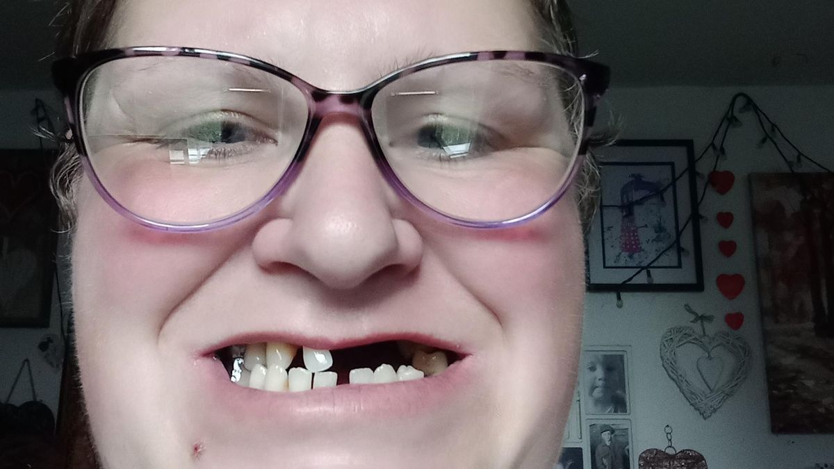 Mãe remove 11 dos próprios dentes porque não tinha dinheiro para ir a um dentista particular ideiasnutritivas.com - Mãe remove 11 dos próprios dentes porque não tinha dinheiro para ir a um dentista particular