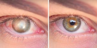 Cientistas criam córnea sintética que faz cegos recuperarem a visão Cientistas criam córnea sintética que faz cegos recuperarem a visão