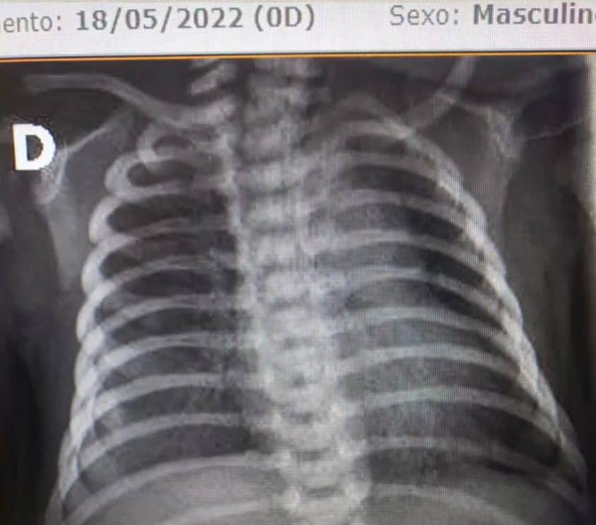 Em cirurgia inédita no Brasil, médica 'queima' tumor de bebê ainda no útero da mãe ideiasnutritivas.com - Em cirurgia inédita no Brasil, médica 'queima' tumor de bebê ainda no útero da mãe