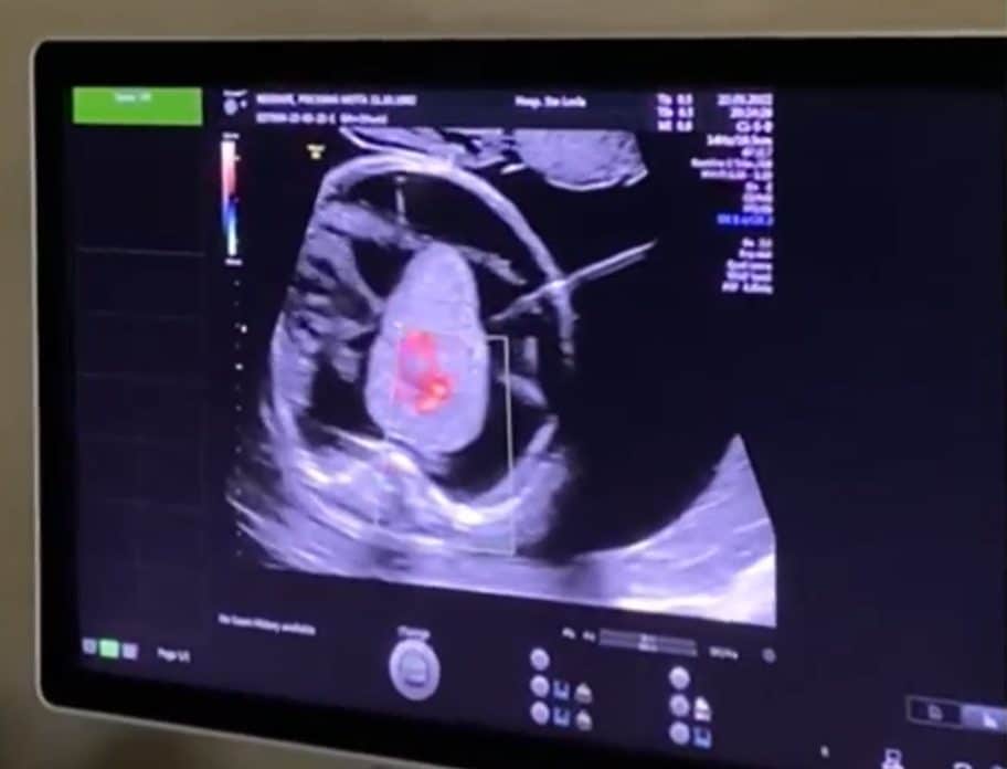 Em cirurgia inédita no Brasil, médica 'queima' tumor de bebê ainda no útero da mãe ideiasnutritivas.com - Em cirurgia inédita no Brasil, médica 'queima' tumor de bebê ainda no útero da mãe