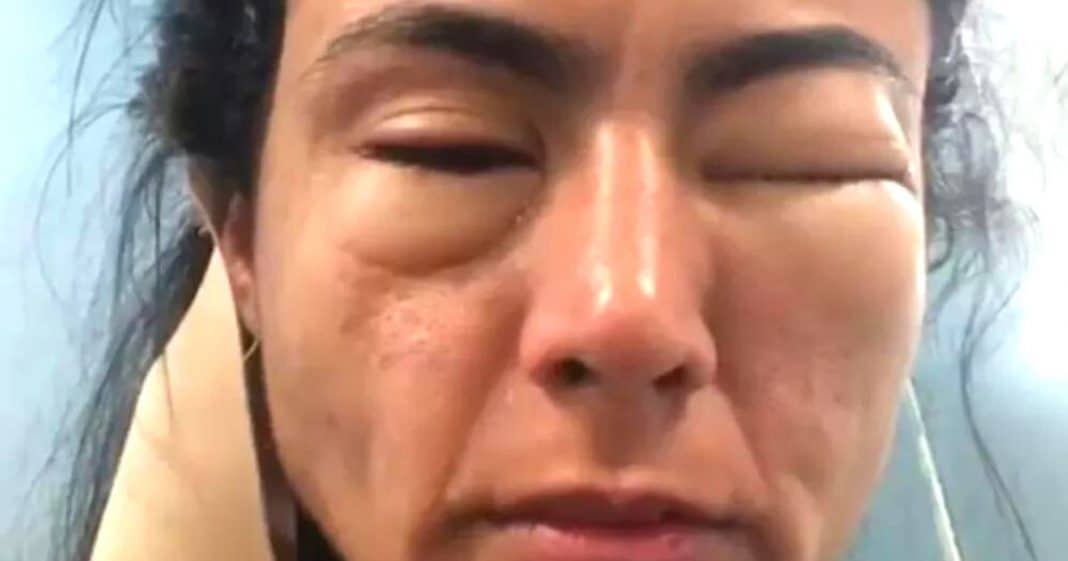 Estudante viraliza ao compartilhar como ficou deformado seu rosto após comer camarão em Copacabana