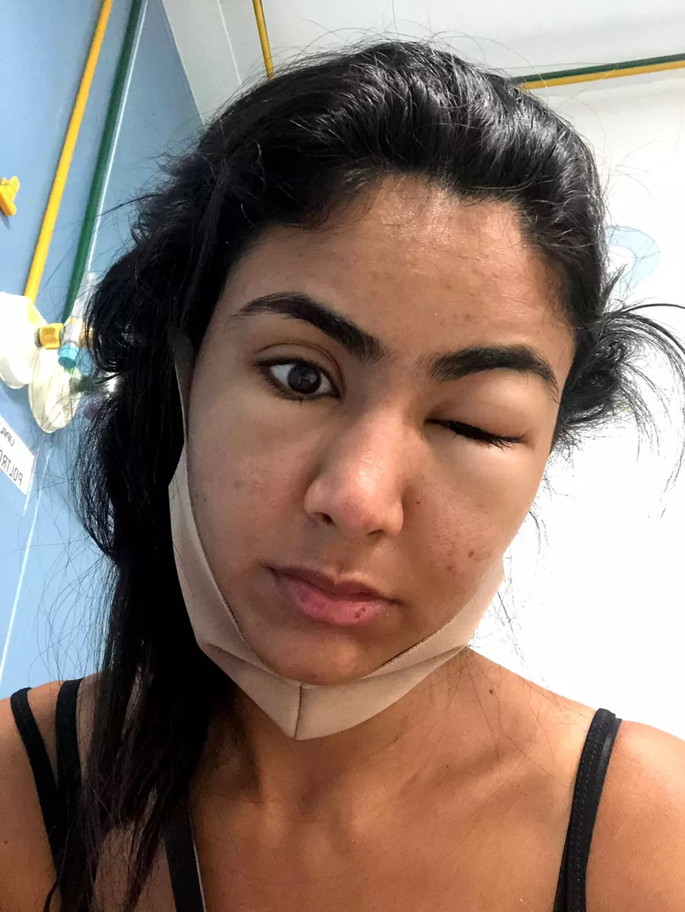 ideiasnutritivas.com - Estudante viraliza ao compartilhar como ficou deformado seu rosto após comer camarão em Copacabana