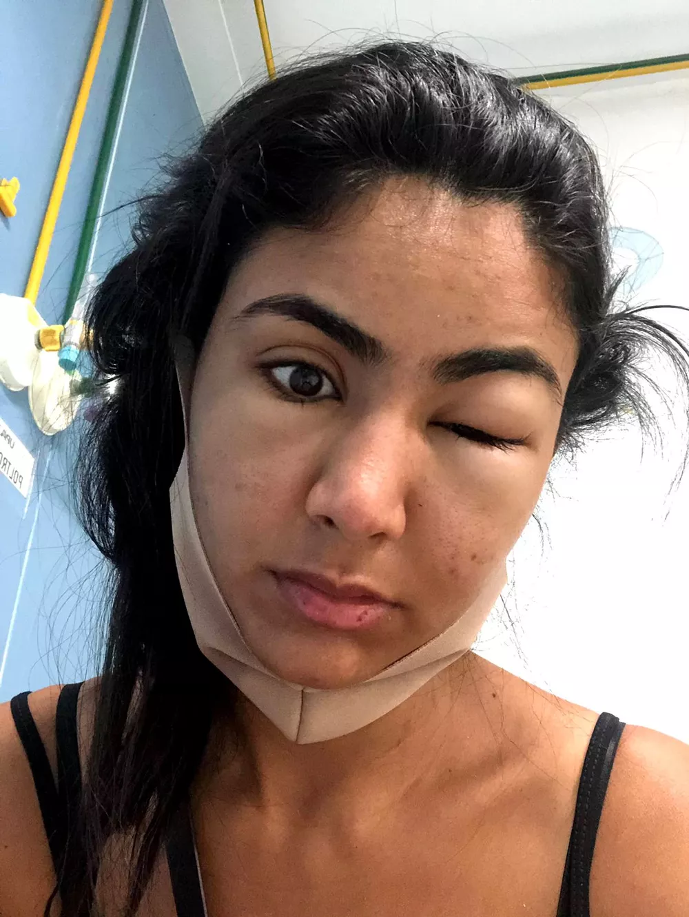 Estudante viraliza ao compartilhar como ficou deformado seu rosto após comer camarão em Copacabana ideiasnutritivas.com - Estudante viraliza ao compartilhar como ficou deformado seu rosto após comer camarão em Copacabana