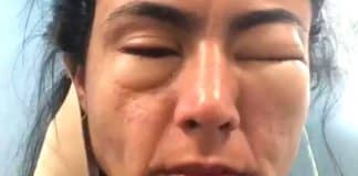 Estudante viraliza ao compartilhar como ficou deformado seu rosto após comer camarão em Copacabana Estudante viraliza ao compartilhar como ficou deformado seu rosto após comer camarão em Copacabana