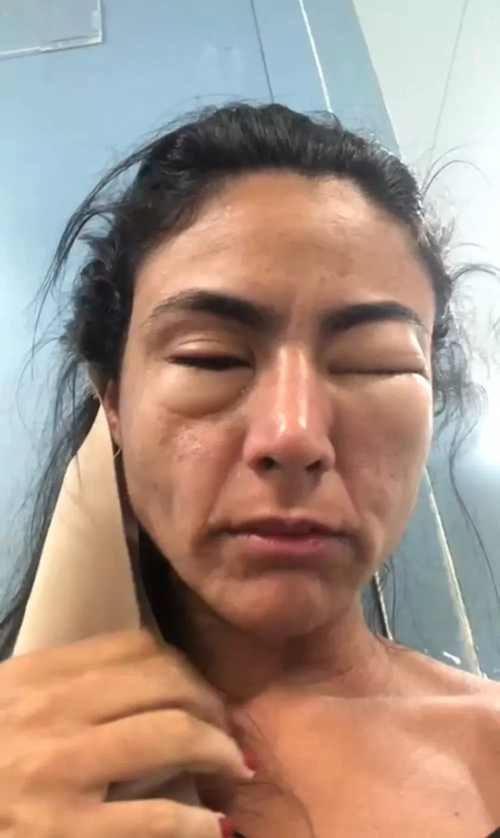 estudante viraliza ao compartilhar como ficou deformado seu rosto apos comer camarao em copacabana - Estudante viraliza ao compartilhar como ficou deformado seu rosto após comer camarão em Copacabana