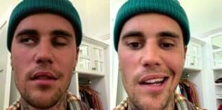 Justin Bieber foi atingido por paralisia facial causado por síndrome rara e cancela shows Justin Bieber foi atingido por paralisia facial causado por síndrome rara e cancela shows