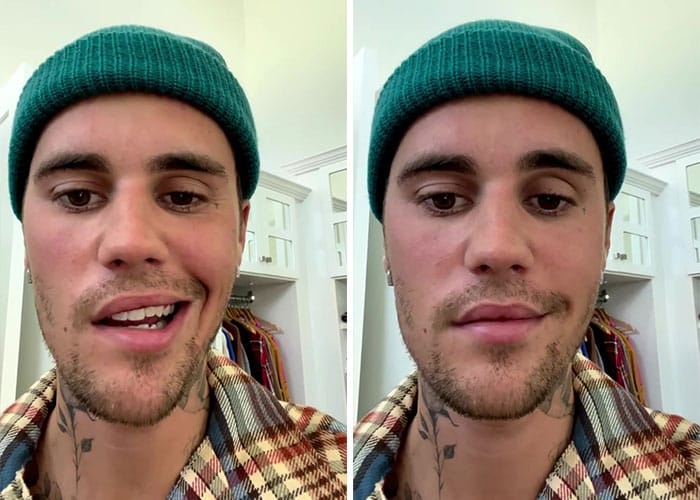 ideiasnutritivas.com - Justin Bieber foi atingido por paralisia facial causado por síndrome rara e cancela shows