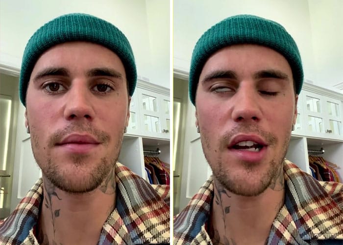 ideiasnutritivas.com - Justin Bieber foi atingido por paralisia facial causado por síndrome rara e cancela shows